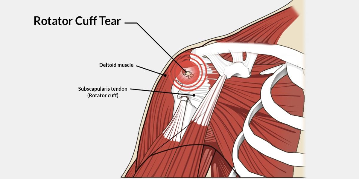 rotary cup injury